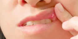 درمان آفت دهان خیراندیش و علت و علائم و راههای پیشگیری