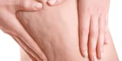 درمان سلولیت پا خیراندیش و علت و علائم و راههای پیشگیری