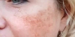 درمان سلولیت صورت خیراندیش و علت و علائم و راههای پیشگیری