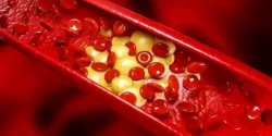 درمان چربی خون خیراندیش و علت و علائم و راههای پیشگیری