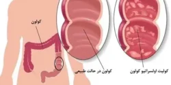 درمان کولیت اولسراتیو خیراندیش و علت و علائم و راههای پیشگیری