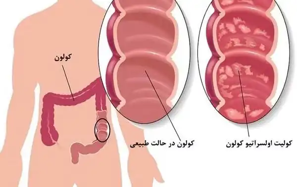 درمان کولیت اولسراتیو خیراندیش و علت و علائم و راههای پیشگیری