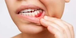 درمان درد لثه خیراندیش و علت و علائم و راههای پیشگیری