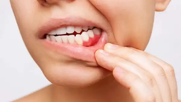 درمان درد لثه خیراندیش و علت و علائم و راههای پیشگیری