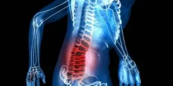 درمان التهاب دیسک کمر خیراندیش و علت و علائم و راههای پیشگیری
