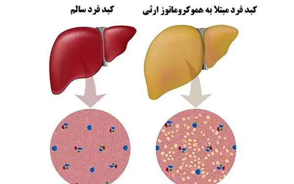 درمان هموکروماتوز خیراندیش و علت و علائم و راههای پیشگیری