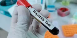 درمان هپاتیت E خیراندیش و علت و علائم و راههای پیشگیری