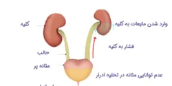 درمان هیدرونفروز خیراندیش و علت و علائم و راههای پیشگیری