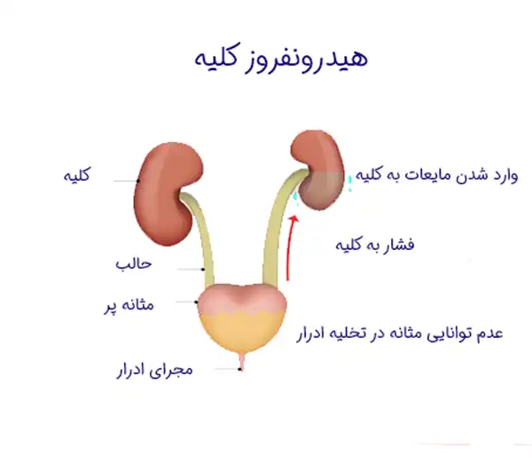 درمان هیدرونفروز خیراندیش و علت و علائم و راههای پیشگیری