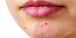 درمان جوش چانه خیراندیش و علت و علائم و راههای پیشگیری