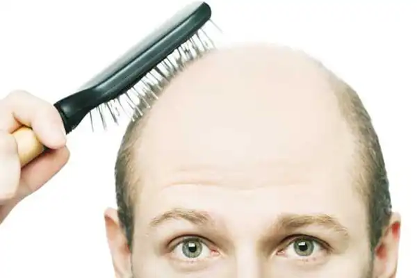 درمان کچلی خیراندیش و علت و علائم و راههای پیشگیری
