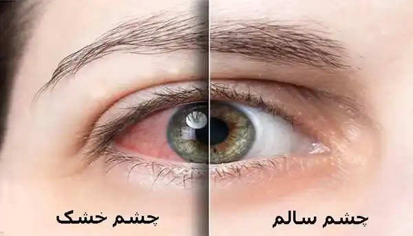 درمان خشکی چشم خیراندیش و علت و علائم و راههای پیشگیری