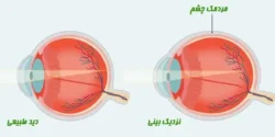 درمان نزدیک بینی خیراندیش و علت و علائم و راههای پیشگیری