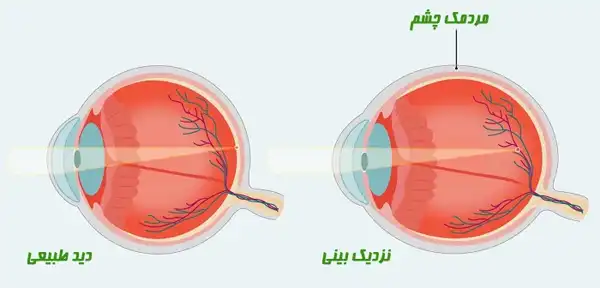 درمان نزدیک بینی خیراندیش و علت و علائم و راههای پیشگیری
