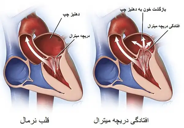 درمان افتادگی دریچه میترال خیراندیش و علت و علائم و راههای پیشگیری