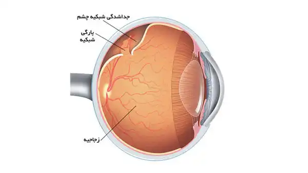 درمان پارگی شبکیه چشم خیراندیش و علت و علائم و راههای پیشگیری