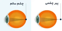 درمان پیر چشمی خیراندیش و علت و علائم و راههای پیشگیری