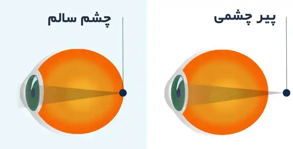 درمان پیر چشمی خیراندیش و علت و علائم و راههای پیشگیری