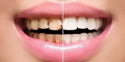 درمان پوسیدگی دندان خیراندیش و علت و علائم و راههای پیشگیری