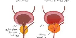 درمان پروستاتیت خیراندیش و علت و علائم و راههای پیشگیری