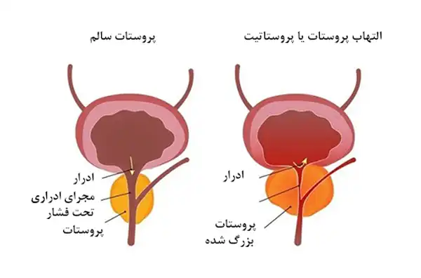 درمان پروستاتیت خیراندیش و علت و علائم و راههای پیشگیری