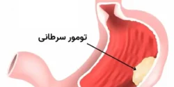 درمان سرطان معده خیراندیش و علت و علائم و راههای پیشگیری