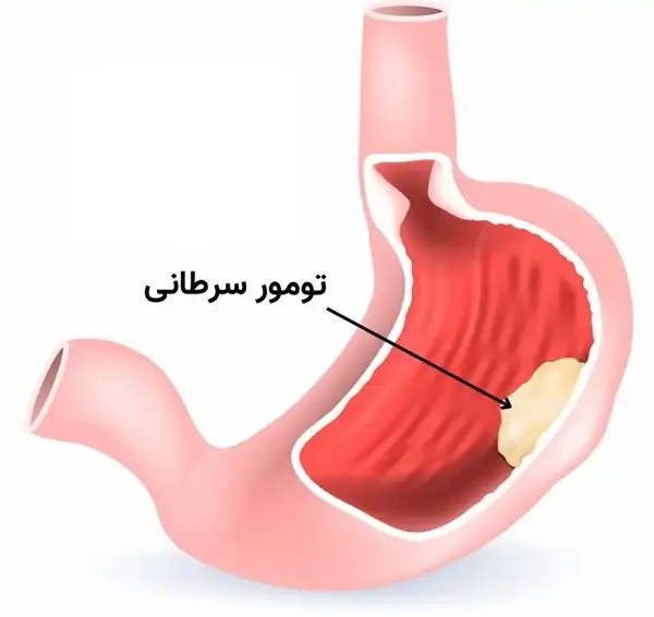 درمان سرطان معده خیراندیش و علت و علائم و راههای پیشگیری