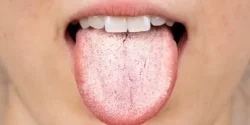 درمان سفیدی زبان خیراندیش و علت و علائم و راههای پیشگیری