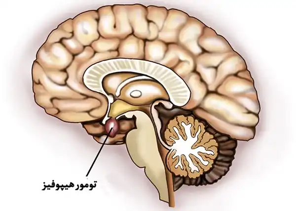 درمان تومور هیپوفیز خیراندیش و علت و علائم و راههای پیشگیری