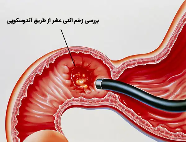 درمان زخم اثنی عشر خیراندیش و علت و علائم و راههای پیشگیری